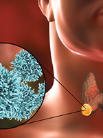 Cabozantinib Active as First-Line Treatment of Differentiated Thyroid Cancer